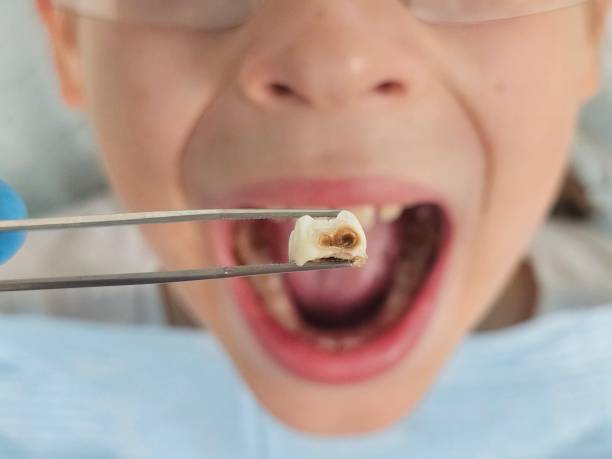 Best Emergency Treatment for Toothache in Tavares, FL